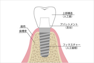 人工歯（上部構造）