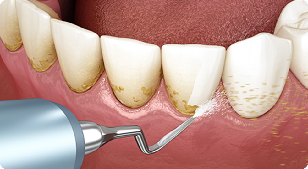 専用の器具を歯の根っこの歯石を取り除いている