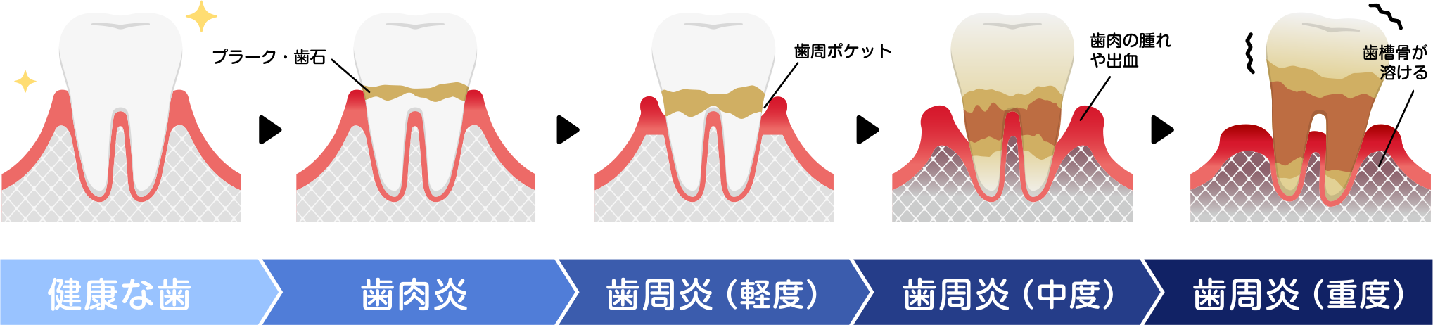 段階に合わせた歯周病治療