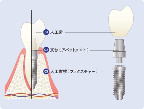 インプラントの構造