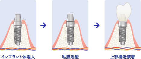 1回法