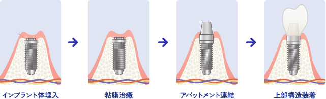 2回法